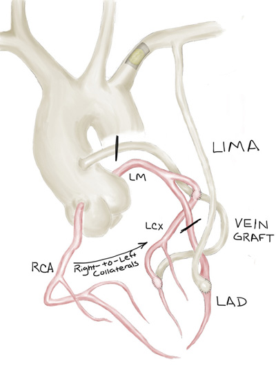 Coronary artery anatomy with subclavian plaque rupture and stenoses.