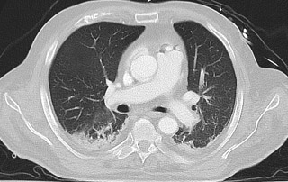 Venous air embolism during power IV contrast administration