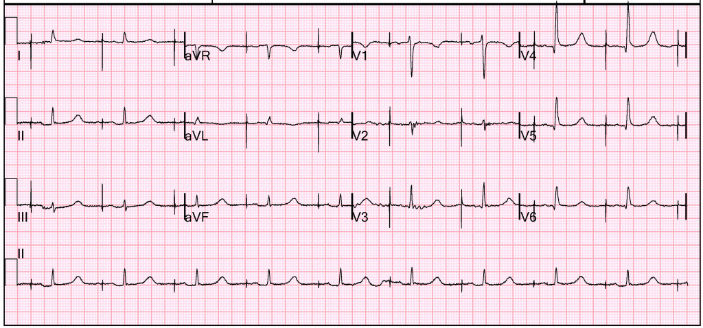 Case16--ECG_After_Transvenous_Pacer_Placed