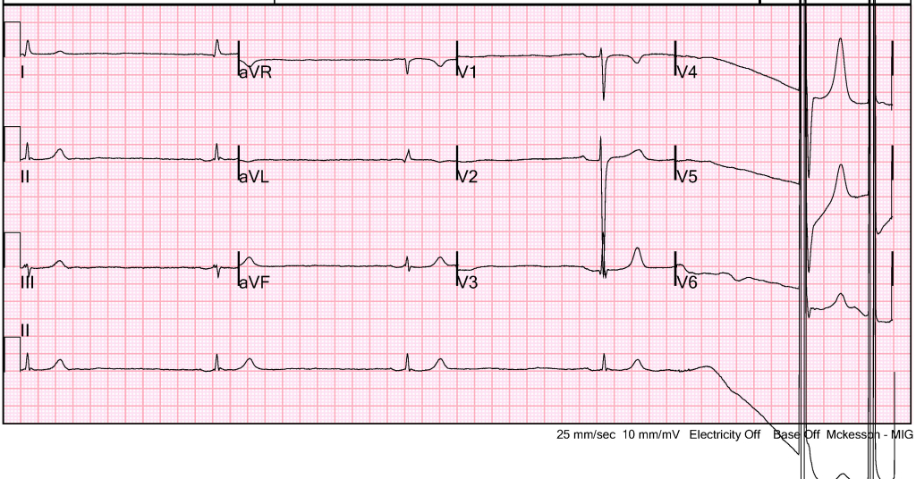 Case16--ECG_with_Transcutaneous_Pacing