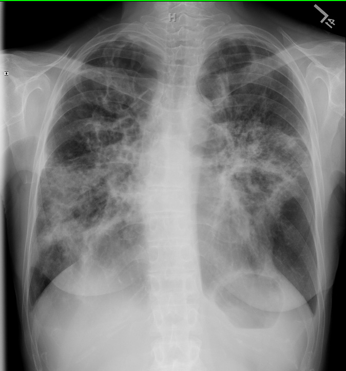 Fullminant Tuberculosis