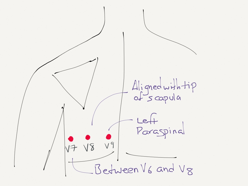 Lead Placement for Posterior ECG