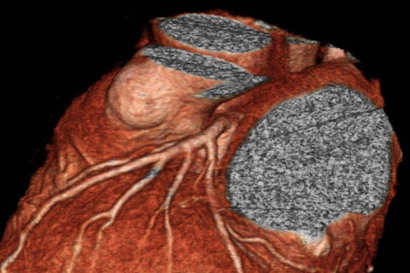 CT Coronary Angiogram LAD