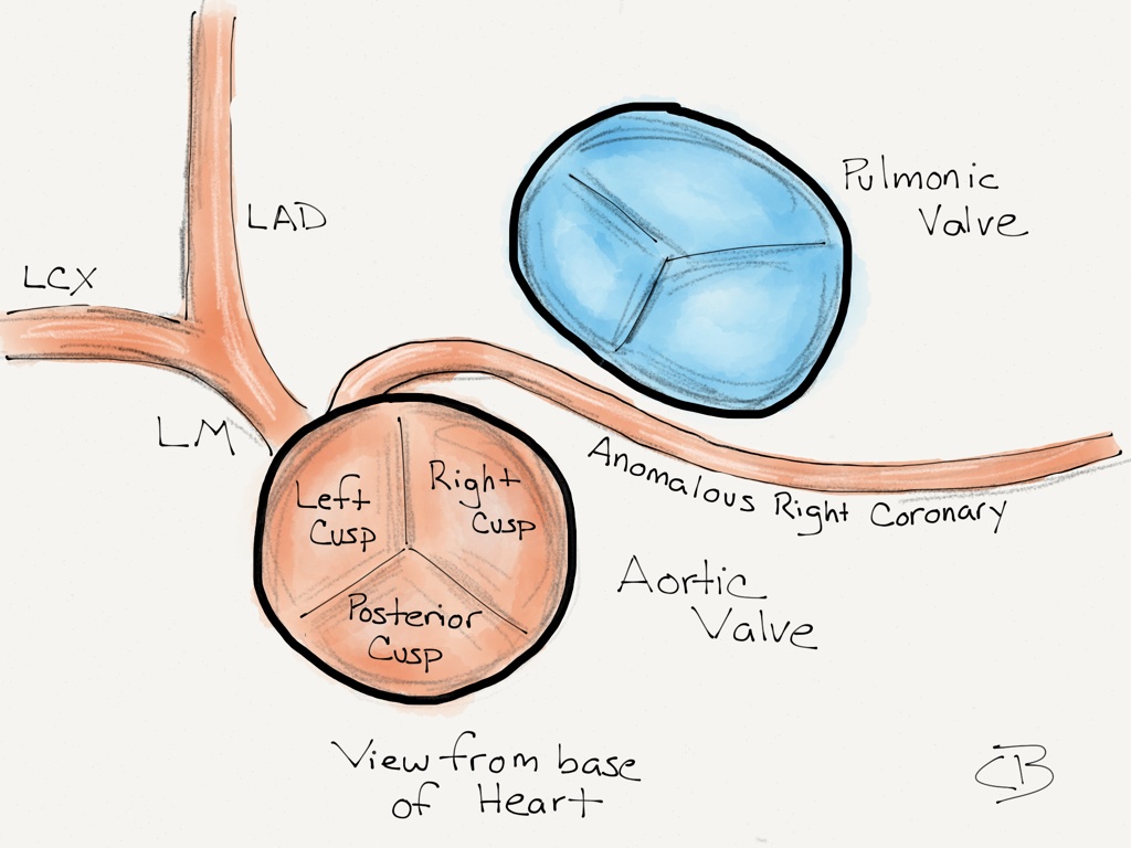 Anomalous-Right-Coronary-Artery-Schematic