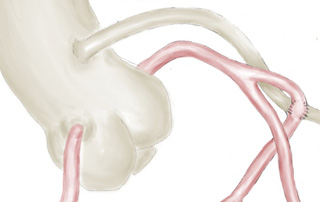 Coronary artery origin at proximal aorta