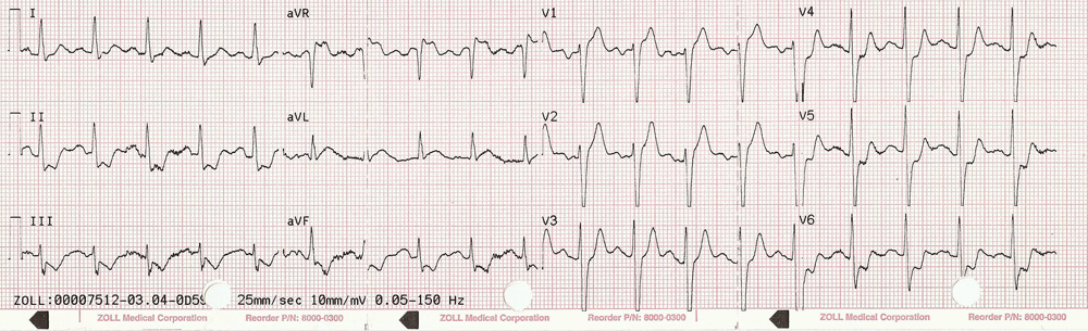 ECG with 2mm of ST-segment elevation in V1, V2, V3, and aVR with diffuse ST depression.