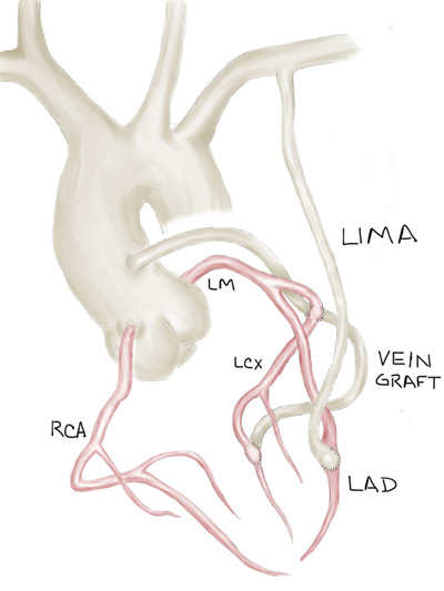 Native coronary arteries and a vein skip graft to proximal LCx then PDA and LIMA to mid-LAD.