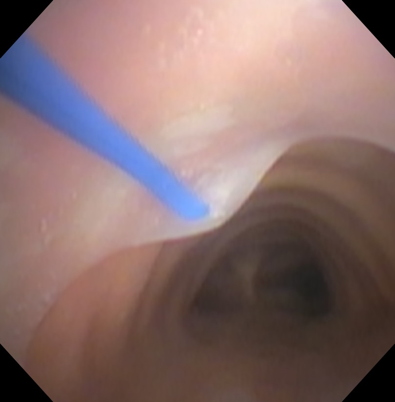 Percutaneous Tracheostomy Initial Bronchoscopic View