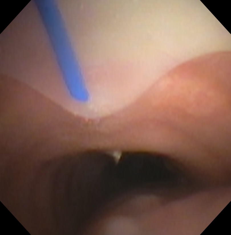 Percutaneous Tracheostomy Needle Puncture Bronchoscopic View