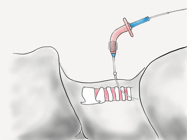 Percutaneous Tracheostomy Tracheal Cannulation With Tracheostomy Tube