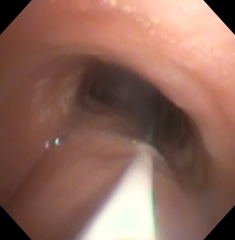 Percutaneous Tracheostomy Wire In Trachea Bronchoscopic Distal View