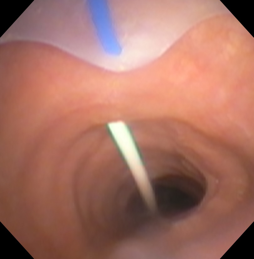 Percutaneous Tracheostomy Wire In Trachea Bronchoscopic Proximal View
