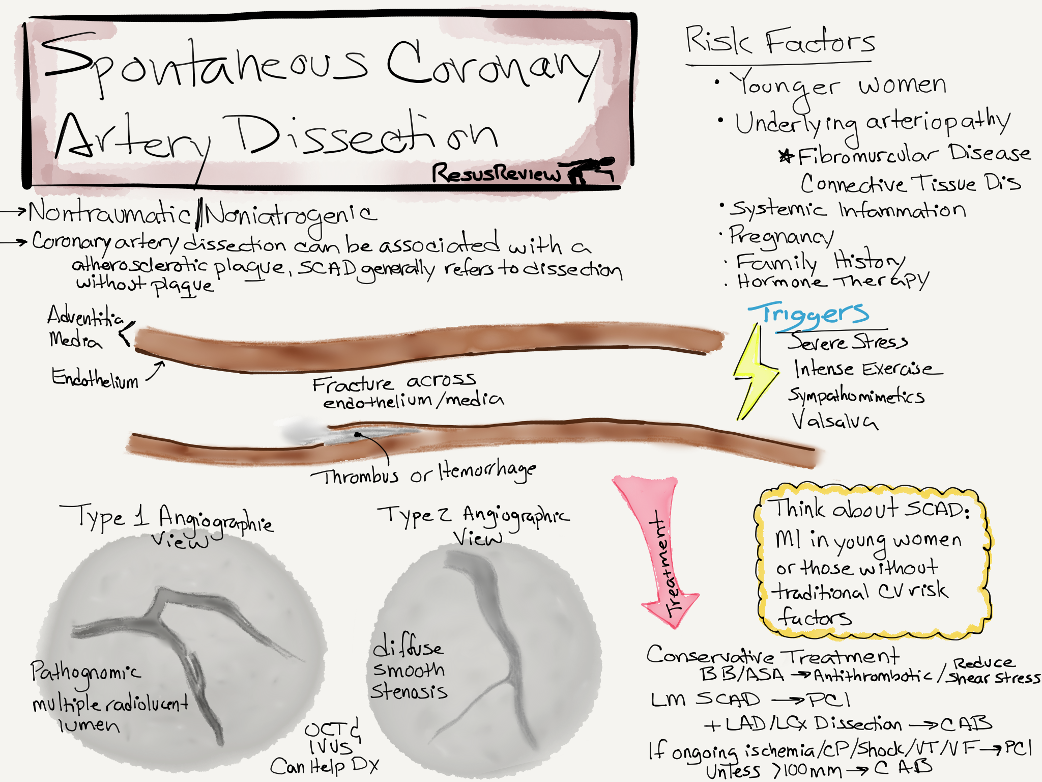 Spontaneous Coronary Artery Dissection