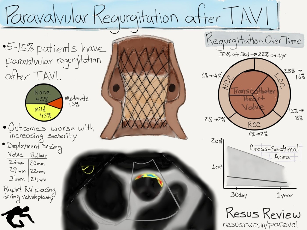 TAVI Paravalvular Regurgitation Evolution