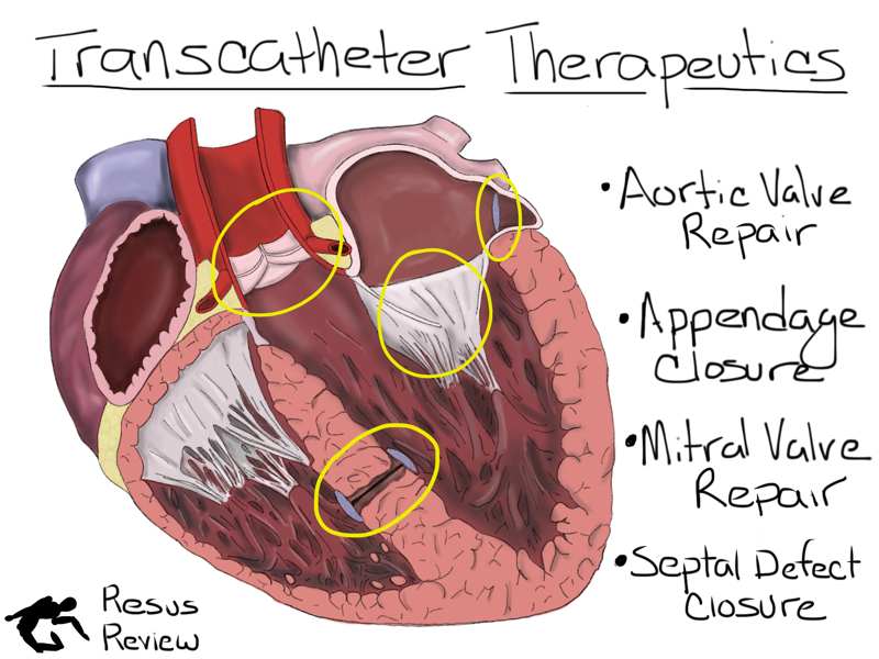 Transcather Cardiac Therapeutics Overview